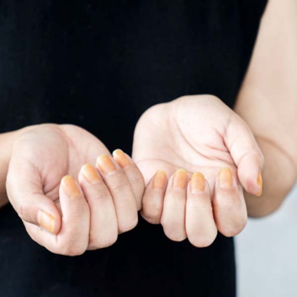 uñas amarillentas