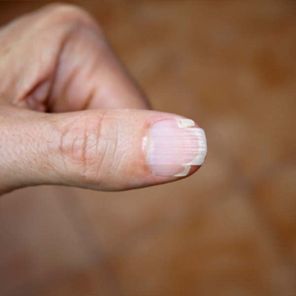 uñas partidas