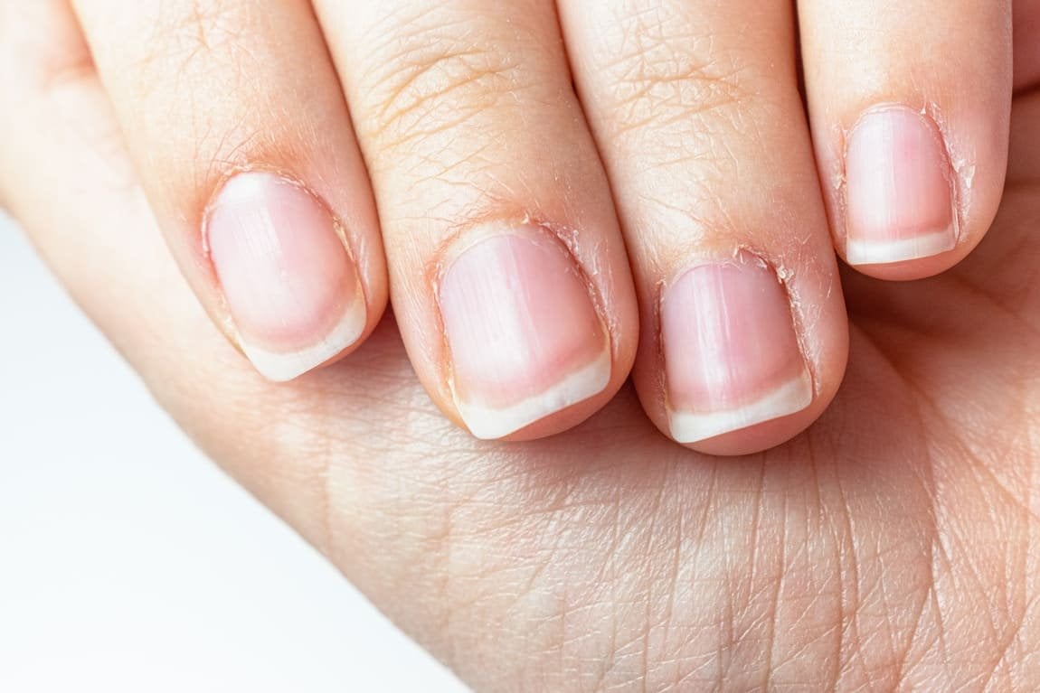 cutículas inflamadas