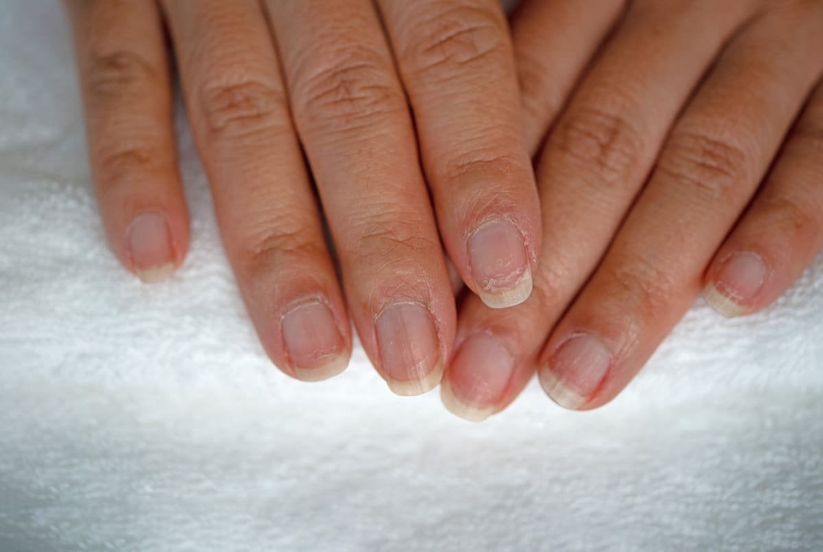 estrias en las uñas