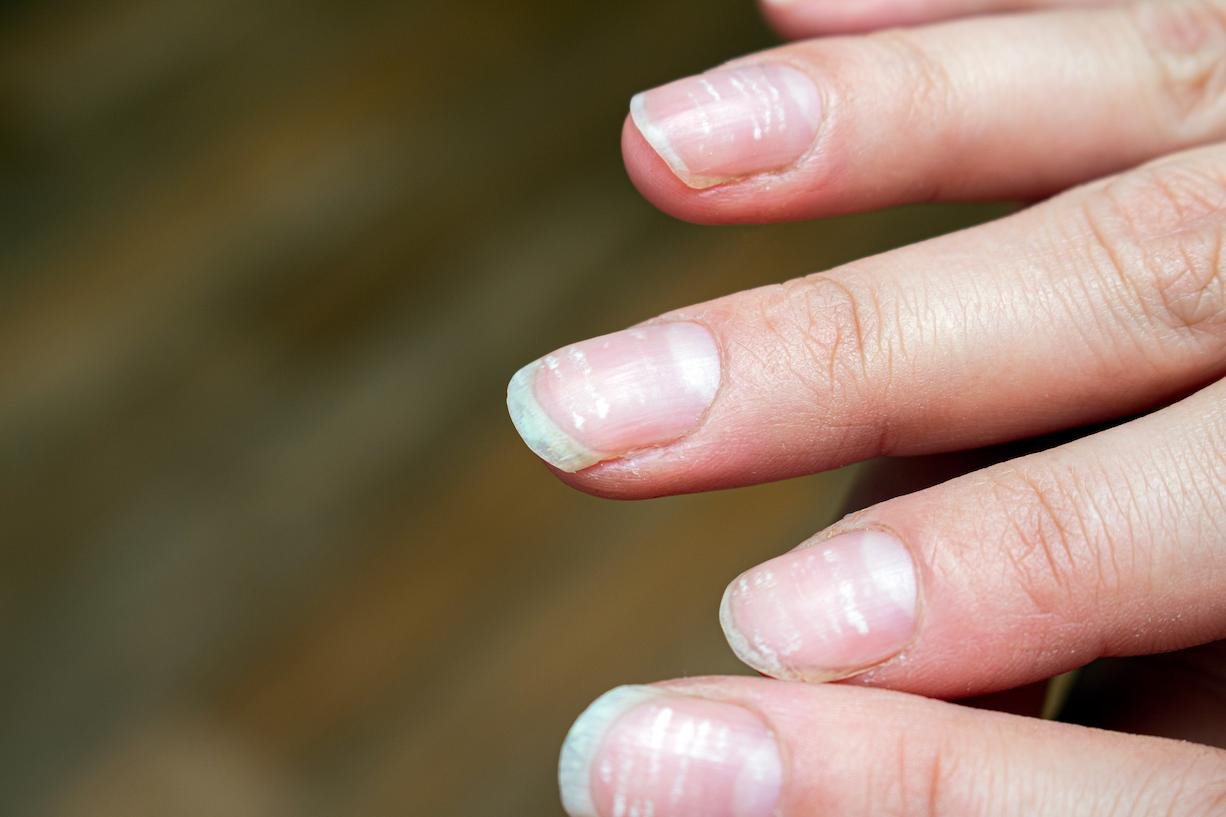uñas con surcos horizontales