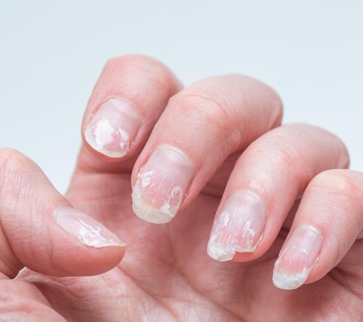 uñas con surcos