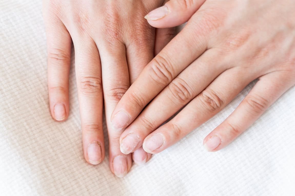 uñas desgastadas