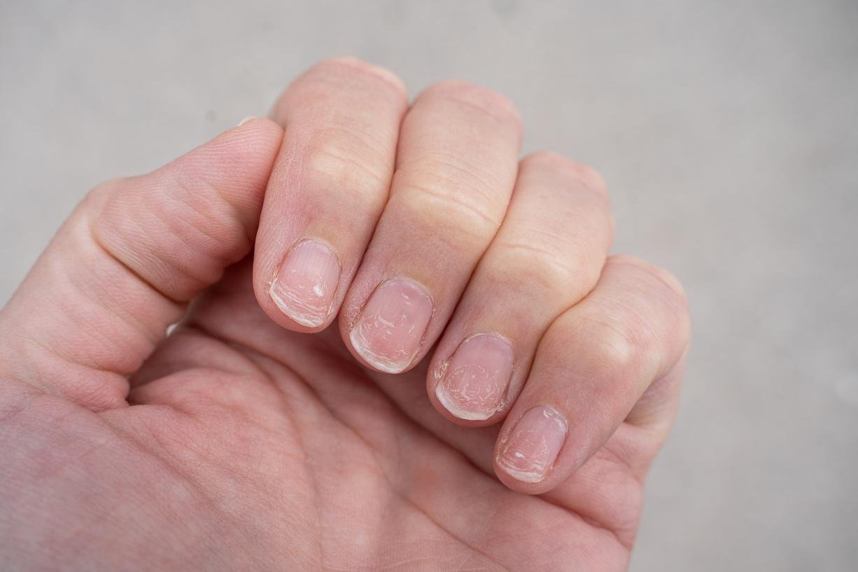 uñas rayadas
