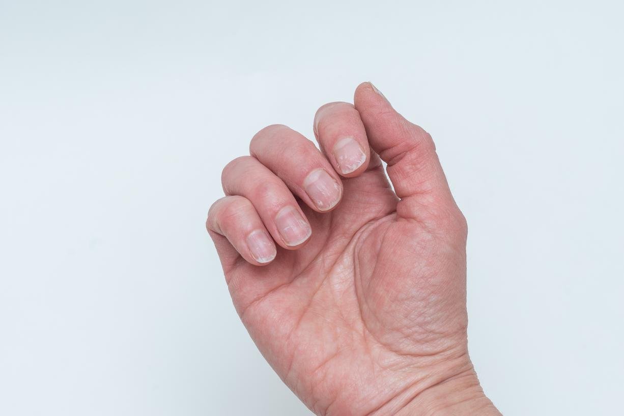 uñas rugosas causas